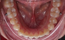 正畸术前口内拍照的标准是什么？规范要点有哪些？