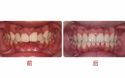 前牙拥挤正畸病例