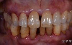 正畸力度过大牙髓炎