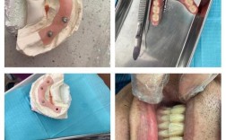 种牙是否必须做CGF？有何作用？