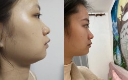 龅牙矫正前后牙齿和脸型变化有多大？效果真的值吗？