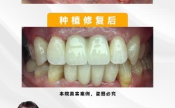种牙康复案例真实吗？效果能维持多久？