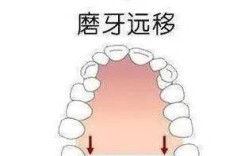 如何用最简单的方法调整磨牙倾斜？