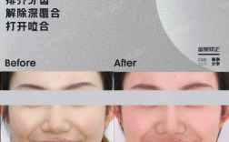 正畸后导致深覆合