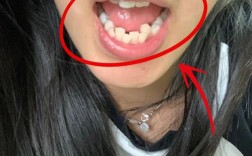 正畸两年后咬合不好