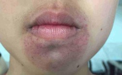 种植牙会导致下巴发紫吗？