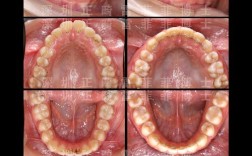 牙齿矫正下巴的变化