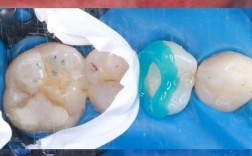 正畸结扎丝划伤牙釉质是操作失误还是材料问题？患者该如何早期发现并科学预防此类损伤？