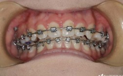 嘉兴二院牙科正畸