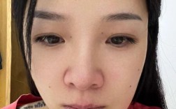 牙齿矫正后脸肿了？是正常反应还是需警惕？