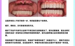 种植牙治疗方法