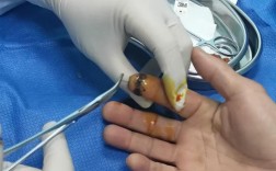 拔髓针的正确方法视频