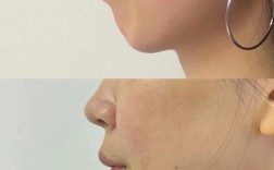 矫正牙齿后脸歪了？矫正真的会让脸变歪吗？