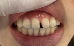 牙齿矫正后出现缝隙，是矫正效果问题还是正常现象？