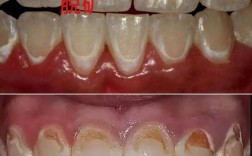 正畸过程牙脱矿