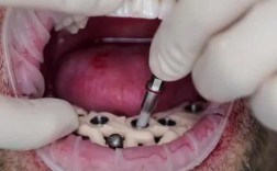 种牙为何要先拔牙？拔牙是种牙必经步骤吗？