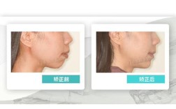 矫正牙齿后上排牙往外凸，是什么原因导致的？