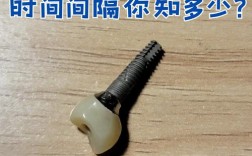 种牙埋件能用多久？使用寿命受哪些因素影响？