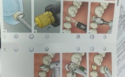 如何正确掌握纤维根管桩的使用方法与步骤？