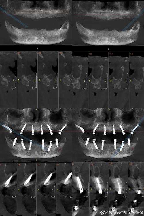 中山实时负重种植牙是什么技术?为何能当天负重使用效果如何?-图1 中山实时负重种植牙是什么技术?为何能当天负重使用效果如何?-图1