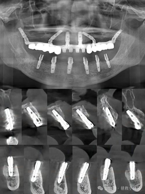 中山实时负重种植牙是什么技术?为何能当天负重使用效果如何?-图2 中山实时负重种植牙是什么技术?为何能当天负重使用效果如何?-图2