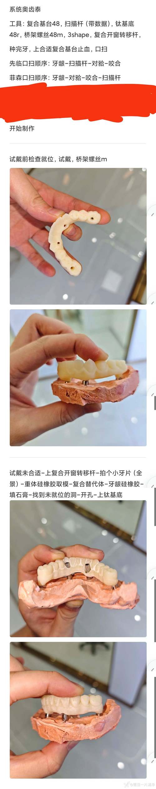 中山实时负重种植牙是什么技术?为何能当天负重使用效果如何?-图3 中山实时负重种植牙是什么技术?为何能当天负重使用效果如何?-图3