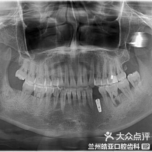 种植牙前后牙龈沟有何变化？术后如何护理牙龈沟？-图3