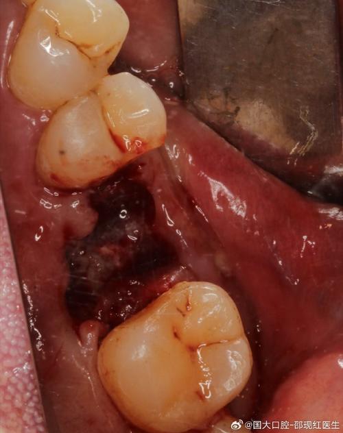 种植牙后口腔为何会发炎？原因分析与应对措施有哪些？-图1