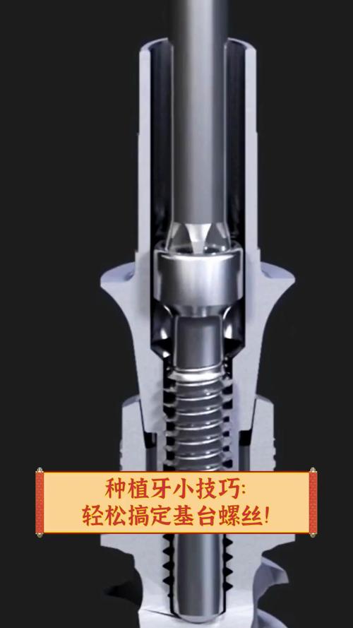 种植牙中央螺丝断裂后如何安全取出？有哪些修复技巧？-图2