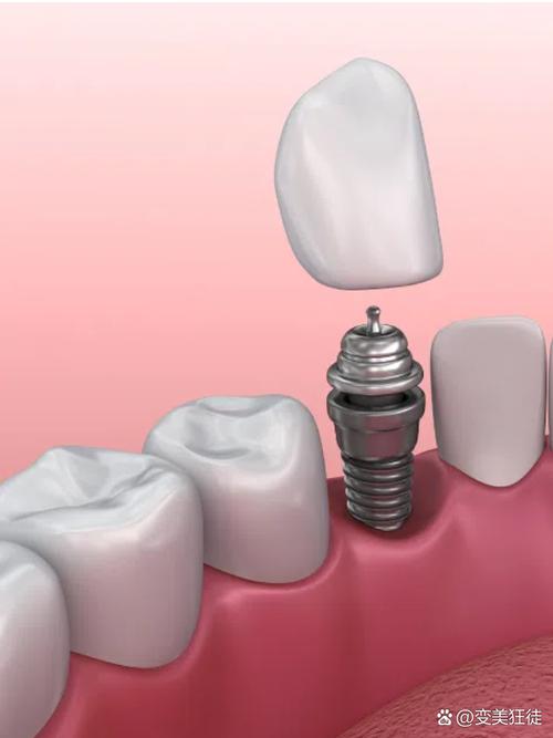 种植牙价格居高不下的原因究竟是什么？技术成本还是材料费用？-图3