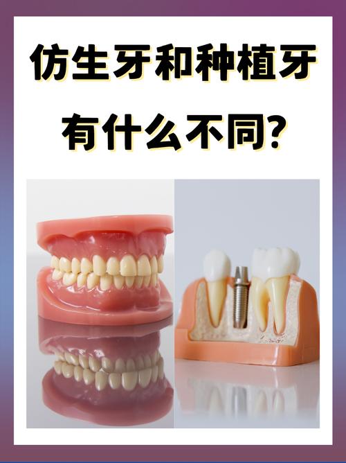 什么叫无种植仿生牙-图2