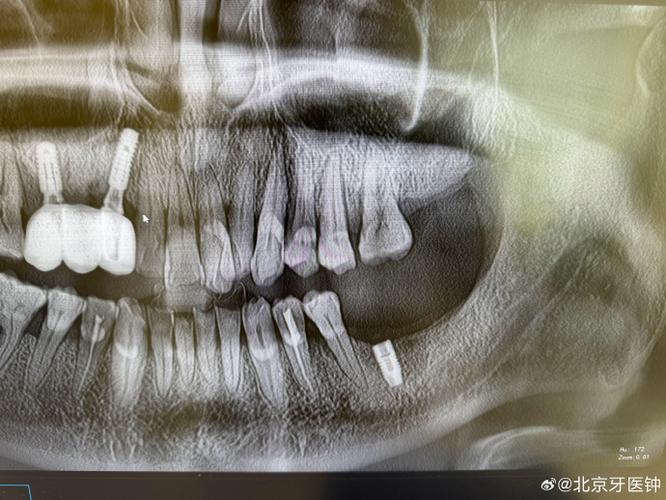 种植牙基台掉了被吃下去,会有什么危险?如何处理?-图2 种植牙基台掉了被吃下去,会有什么危险?如何处理?-图2