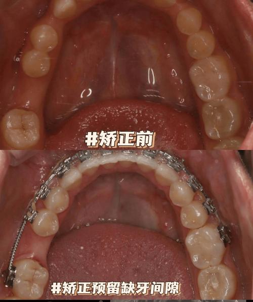空牙种植矫正怎么做？效果与注意事项有哪些？-图3