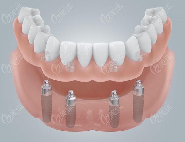 郑州种植牙哪家最专业?选机构、看技术要注意啥?-图3 郑州种植牙哪家最专业?选机构、看技术要注意啥?-图3