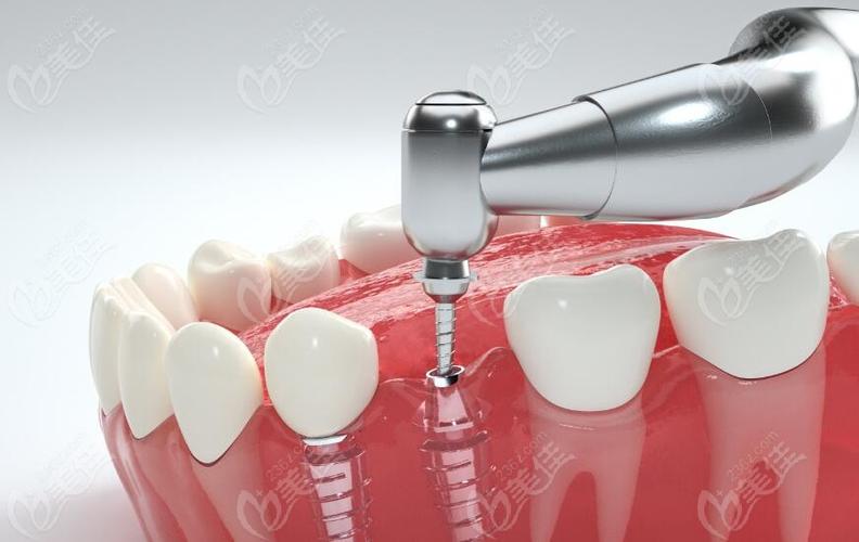 二代种植牙效果如何？是否适合所有人？-图1