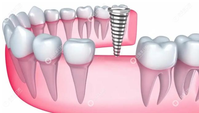 二代种植牙效果如何？是否适合所有人？-图2