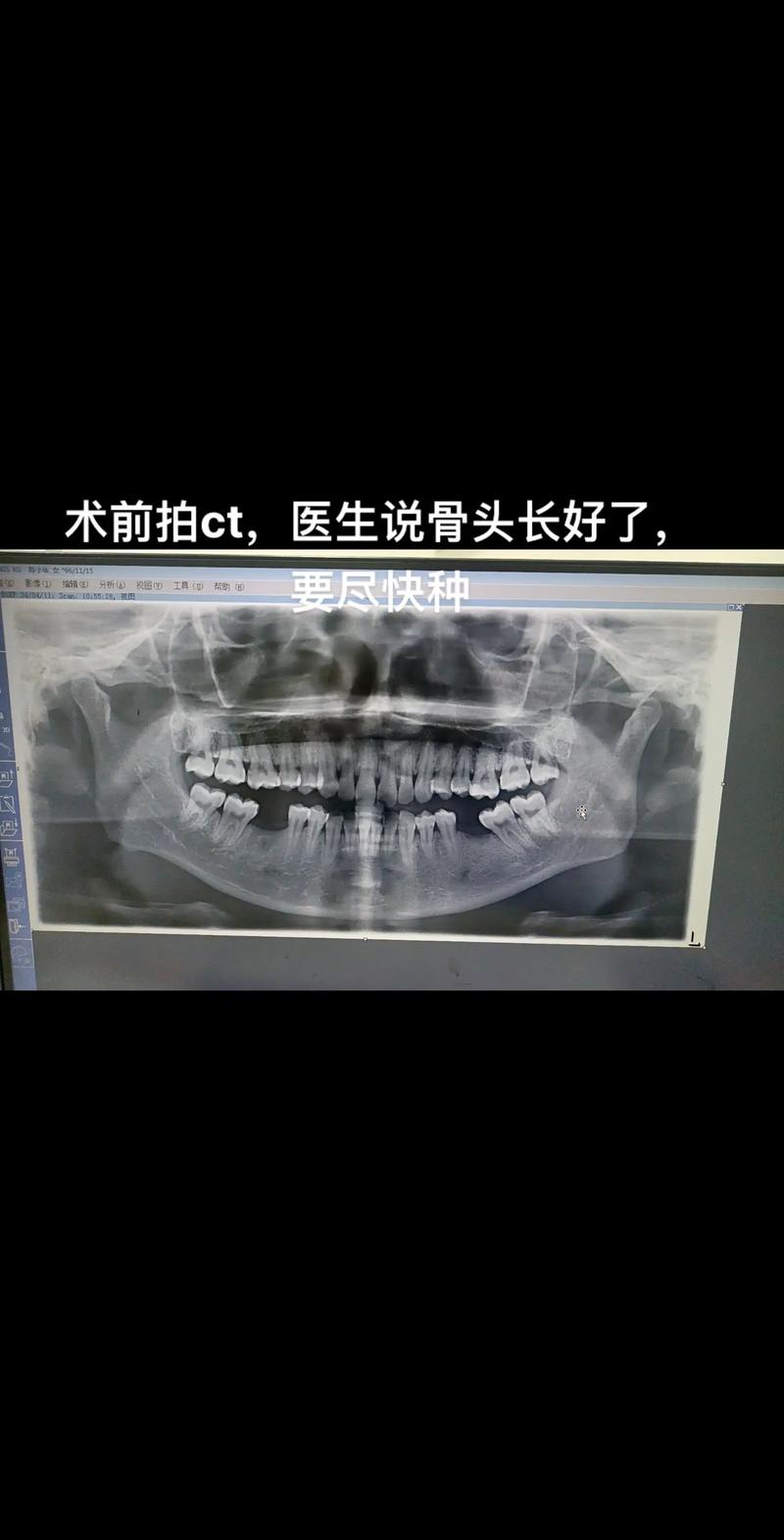 为什么拔牙后要等一两年才能做种植牙？恢复期的重要性是什么？-图2