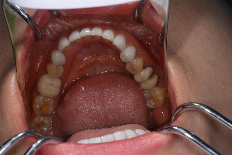 上海哪里治疗种植牙最好？-图3