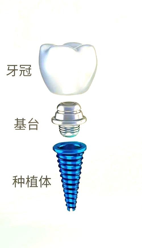 种植牙非抗基台是什么？它的作用、优势及适用范围有哪些？-图1