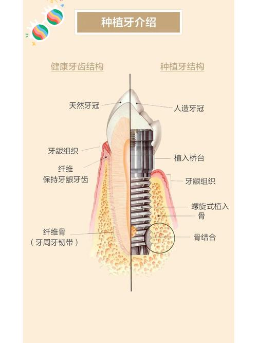 种植牙非抗基台是什么？它的作用、优势及适用范围有哪些？-图2