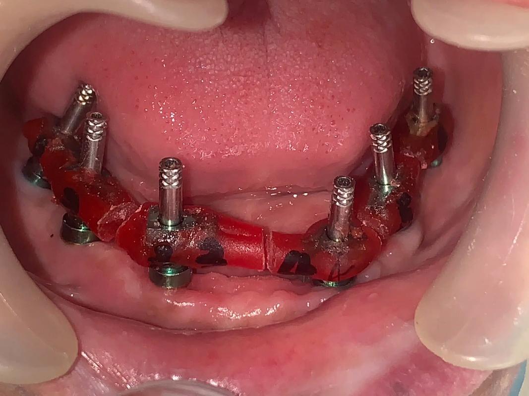 种植牙能取下来吗？-图1