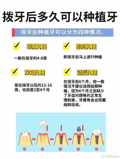 种植牙怎么拔掉?操作方法与步骤详解-图1 种植牙怎么拔掉?操作方法与步骤详解-图1