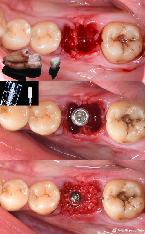 保留牙根种植牙，比传统种植好在哪？-图3