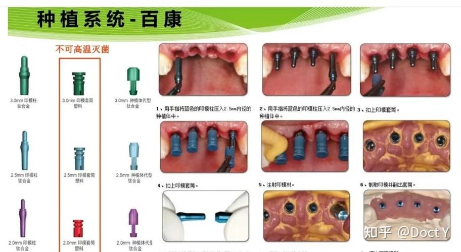 美国种植牙品牌有哪些？目前市面上有哪些热门的美国种植牙品牌？-图2