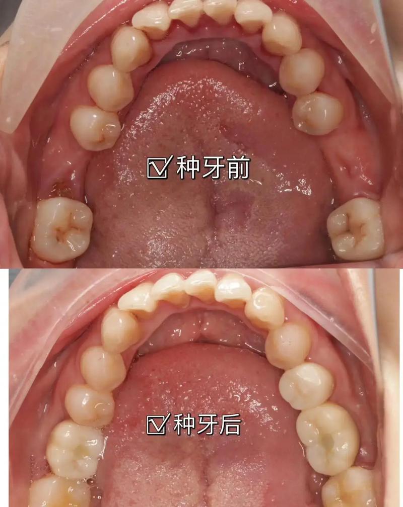 种植牙与真牙有何本质区别?功能与寿命是否相同?-图2 种植牙与真牙有何本质区别?功能与寿命是否相同?-图2