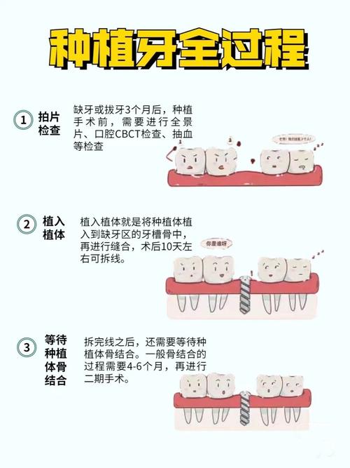 种植牙怎么做？揭秘种植牙的过程、步骤与原理-图2