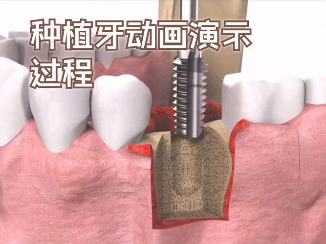 种植全牙过程图片-图2