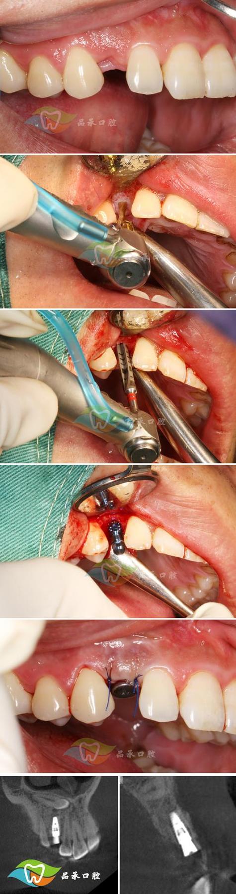 种植全牙过程图片-图3