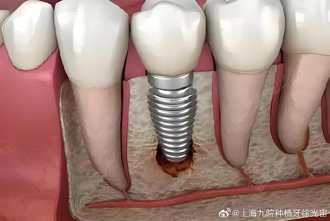 上海种植牙即刻种植效果如何?适合哪些人?价格贵不贵呢?-图1 上海种植牙即刻种植效果如何?适合哪些人?价格贵不贵呢?-图1