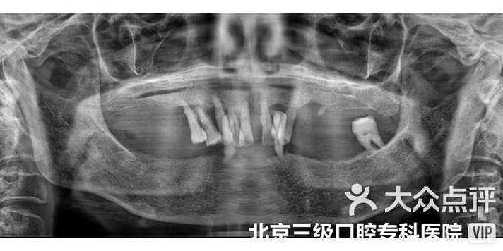 上海种植牙即刻种植效果如何？适合哪些人？价格贵不贵呢？-图2